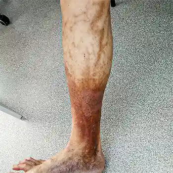 коричневые пятна и гиперпигментация на ногах при болезнях вен мой блог о венах
