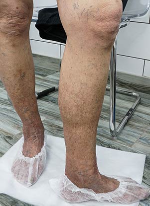 коричневые пятна на ногах, пигментация кожи ног