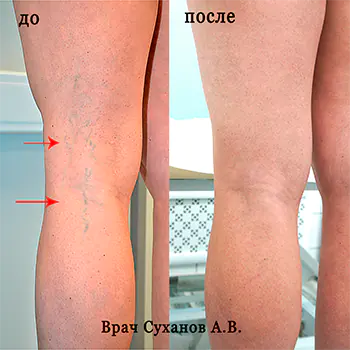 Результат склеротерапии сосудистых звездочек на ногах